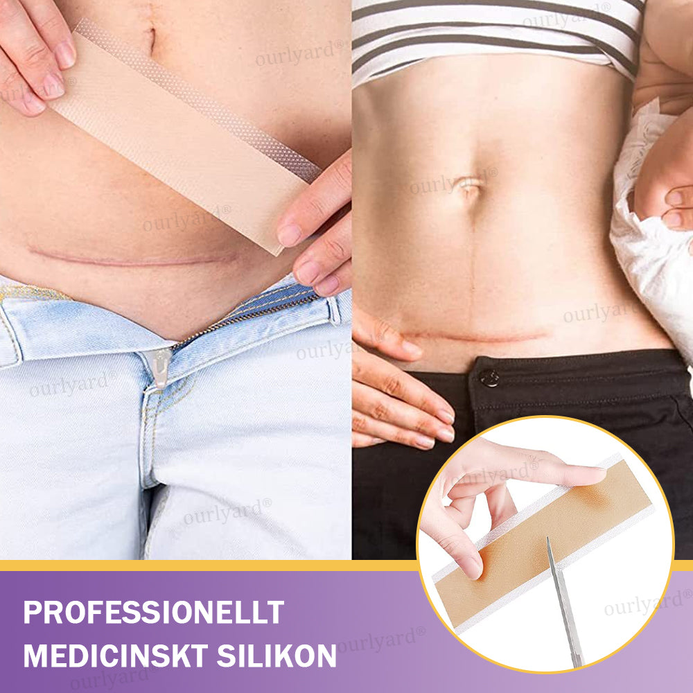 ✅Officiell butik | Ourlyard® Hyaluronsyra Nano Microneedle Repair Tape🏥(Behandling av gamla och nya ärr, minskning av kirurgiska ärr, bristningar, keloider, akne, brännskador, vårtor, dermatomer och åderbråck)