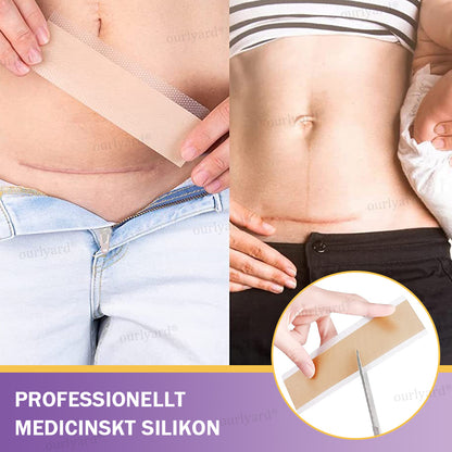 ✅Officiell butik | Ourlyard® Hyaluronsyra Nano Microneedle Repair Tape🏥(Behandling av gamla och nya ärr, minskning av kirurgiska ärr, bristningar, keloider, akne, brännskador, vårtor, dermatomer och åderbråck)