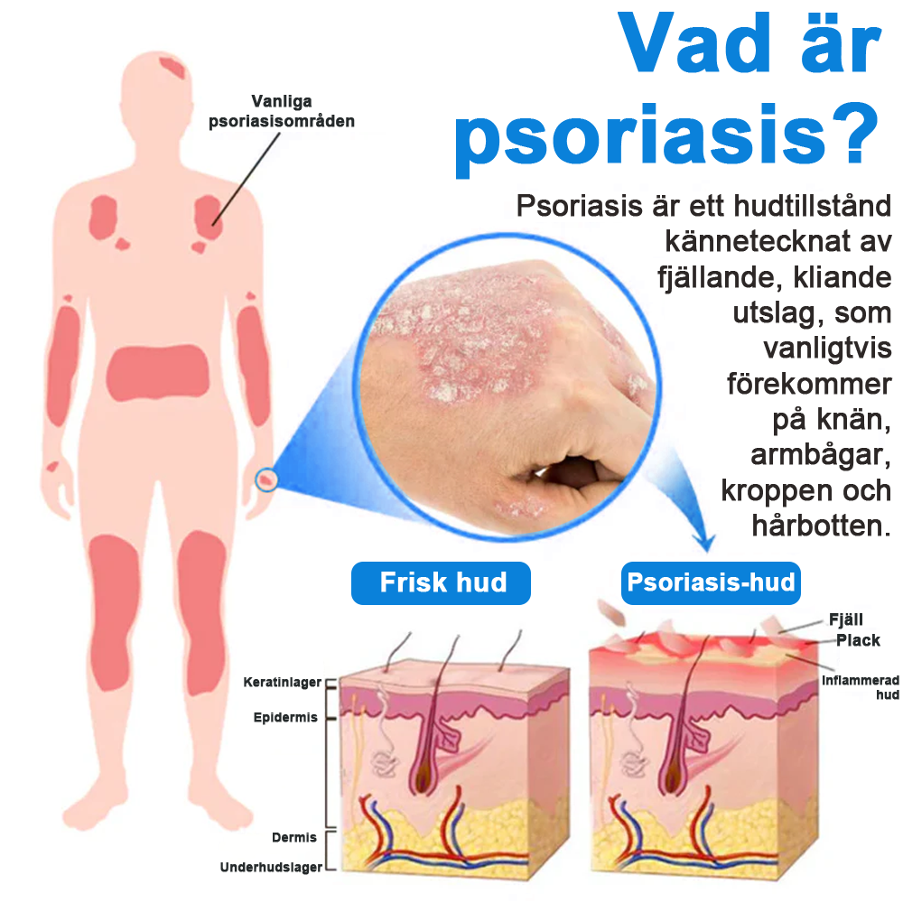 ✅Officiell butik: Zvoevo® Magnesium Herbal Psoriasis Spray ChatGPT said: (Lindrar psoriasis och eksem, förbättrar bakteriella infektioner i genitalområdet, behandlar akne och vårtor, lindrar ledvärk och neuropatisk smärta)