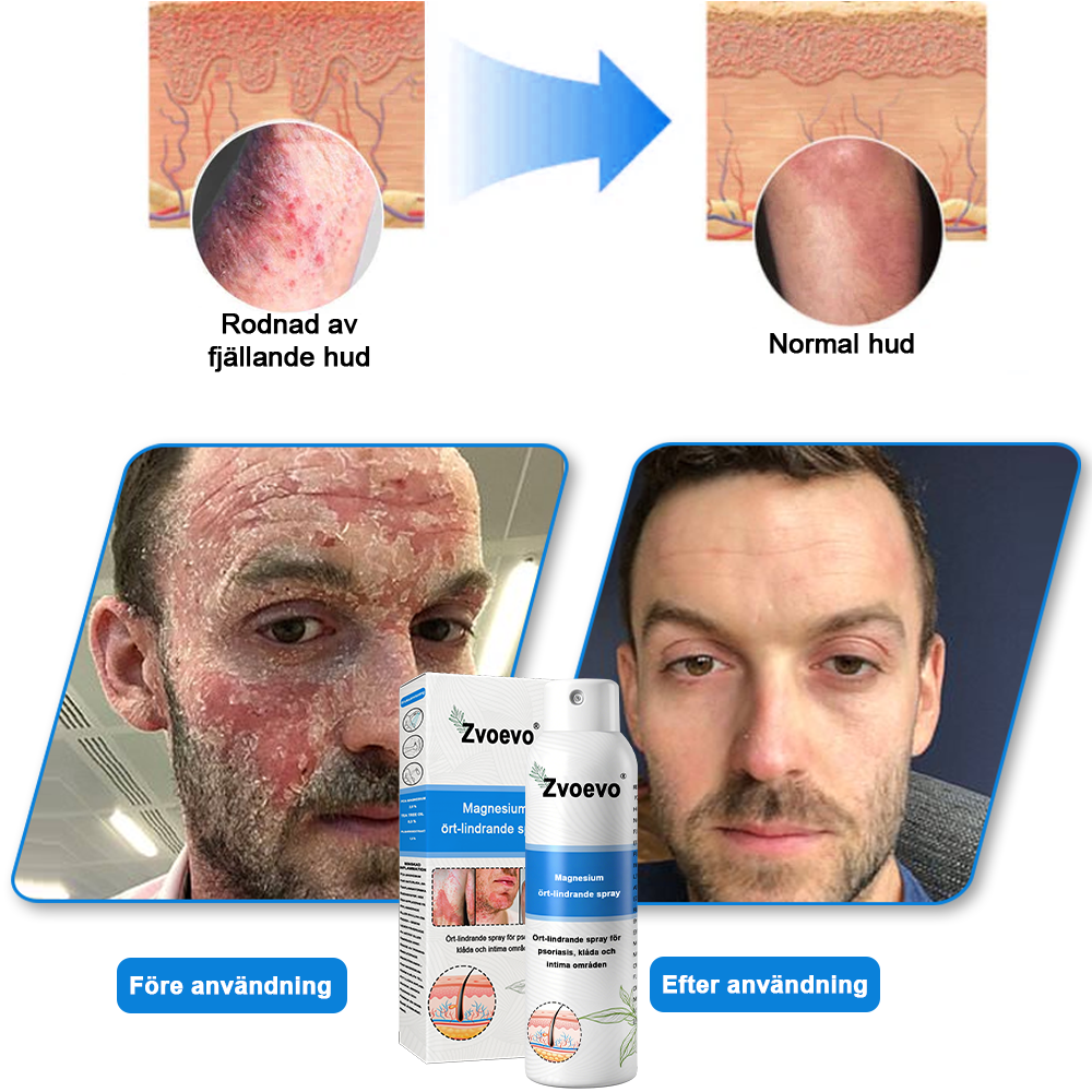 ✅Officiell butik: Zvoevo® Magnesium Herbal Psoriasis Spray ChatGPT said: (Lindrar psoriasis och eksem, förbättrar bakteriella infektioner i genitalområdet, behandlar akne och vårtor, lindrar ledvärk och neuropatisk smärta)