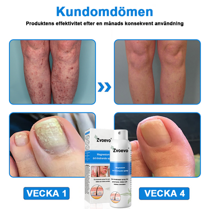 ✅Officiell butik: Zvoevo® Magnesium Herbal Psoriasis Spray ChatGPT said: (Lindrar psoriasis och eksem, förbättrar bakteriella infektioner i genitalområdet, behandlar akne och vårtor, lindrar ledvärk och neuropatisk smärta)